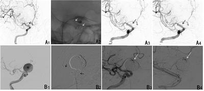 Pipeline Embolization Device for the Treatment of Ruptured Intracerebral Aneurysms: A Multicenter Retrospective Study